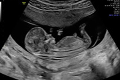 Ultraschallbild eines ungeborenen Kindes