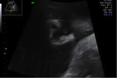 Ultraschallbild im Rahmen der dritten Ultraschalluntersuchung der Schwangerschaftsvorsorge