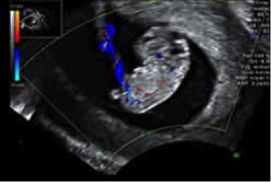 Ultraschallbild im Rahmen der ersten Ultraschalluntersuchung der Schwangerschaftsvorsorge