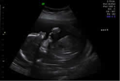 Ultraschallbild im Rahmen der zweiten Ultraschalluntersuchung der Schwangerschaftsvorsorge